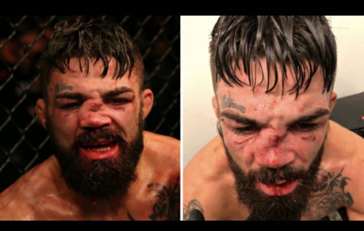UFC Fighter Mike Perry Suffers One Of worst broken noses you'll ever see